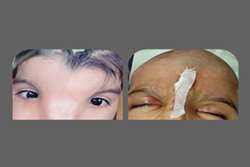 ناهنجاری چهره و جمجمه دختر 4 ساله درمان شد