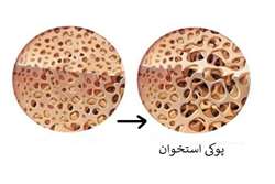 چگونه خطر پوکی استخوان را در دوران کرونا کاهش دهیم؟