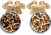 چگونه می توانیم خطر ابتلا به پوکی استخوان را کاهش دهیم؟