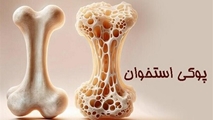 پوکی استخوان و شیوه صحیح زندگی 