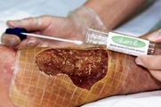 استفاده پزشکی از حشرات در طب سنتی (درمان با حشرات)
